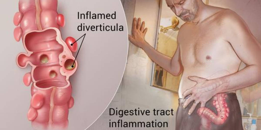 Dealing with Colon Disease